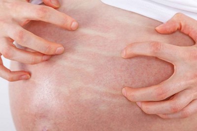 Đang mang thai mà bị bệnh Eczema thì phải làm sao?